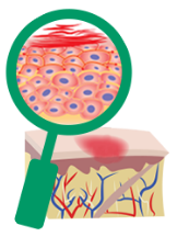 Vista ampliada de las células de la piel en pacientes con eczema moderado a grave no controlado (dermatitis atópica)
