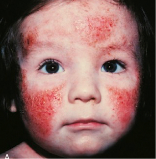 Moderate-to-Severe eczema on light, white, pale, fair skin on a small child's face