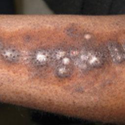 Prurigo nodularis (PN) on a patient's arm who is not on DUPIXENT® (dupilumab)