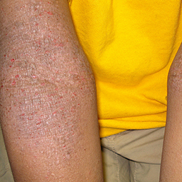 Moderate-to-Severe eczema on dark, brown, black skin on arm