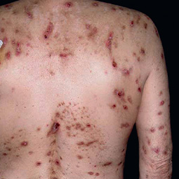 Prurigo nodularis (PN) on a patient's back who is not on DUPIXENT® (dupilumab)