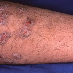 Prurigo Nodularis (PN) on a patient's leg who is not on DUPIXENT® (dupilumab)
