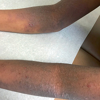 Moderate-to-Severe eczema on dark, brown, black skin on arm