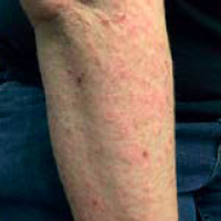 Moderate-to-Severe eczema on light, white, pale, fair skin on arm