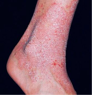 Moderate-to-Severe eczema on light, white, pale, fair skin on foot & ankle