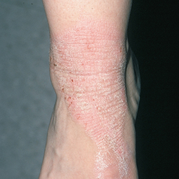 Moderate-to-Severe eczema on light, white, pale, fair skin on ankle