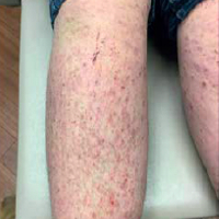 Moderate-to-Severe eczema on light, white, pale, fair skin on arm