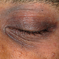 Moderate-to-Severe eczema on dark, brown, black skin on eyes