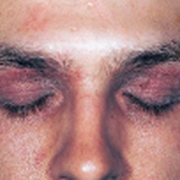 Moderate-to-Severe eczema on light, white, pale, fair skin on eyes & face