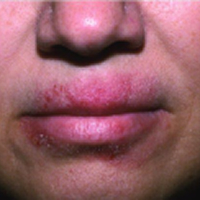 Moderate-to-Severe eczema on light, white, pale, fair skin on lips