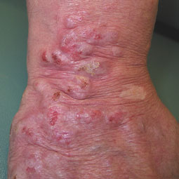 Prurigo Nodularis (PN) on patient's hand and wrist who is not on DUPIXENT® (dupilumab)