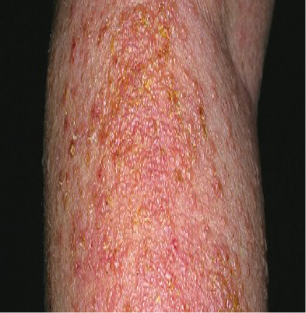 Moderate-to-Severe eczema on light, white, pale, fair skin on arm