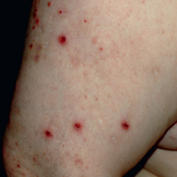 Prurigo nodularis (PN) on a patient's arm who is not on DUPIXENT® (dupilumab)