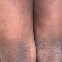 Moderate-to-Severe eczema on dark, brown, black skin on legs