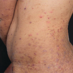 Prurigo nodularis (PN) on a patient's torso who is not on DUPIXENT® (dupilumab)