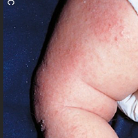 Moderate-to-Severe eczema on light, white, pale, fair skin on a small child's leg