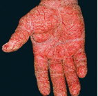 Moderate-to-Severe eczema on light, white, pale, fair skin on hand