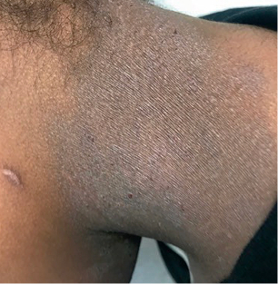 Moderate-to-Severe eczema on dark, brown, black skin on neck