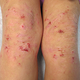Moderate-to-Severe eczema on light, white, pale, fair skin on legs