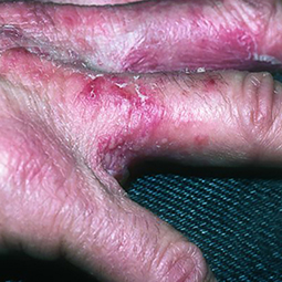 Moderate-to-Severe eczema on light, white, pale, fair skin on hand