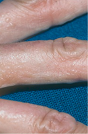 Moderate-to-Severe eczema on light, white, pale, fair skin on finger