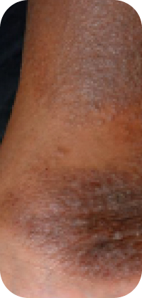Moderate-to-Severe eczema on dark, brown, black skin on ankle